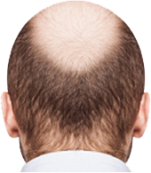 Hair Transplant Surgery