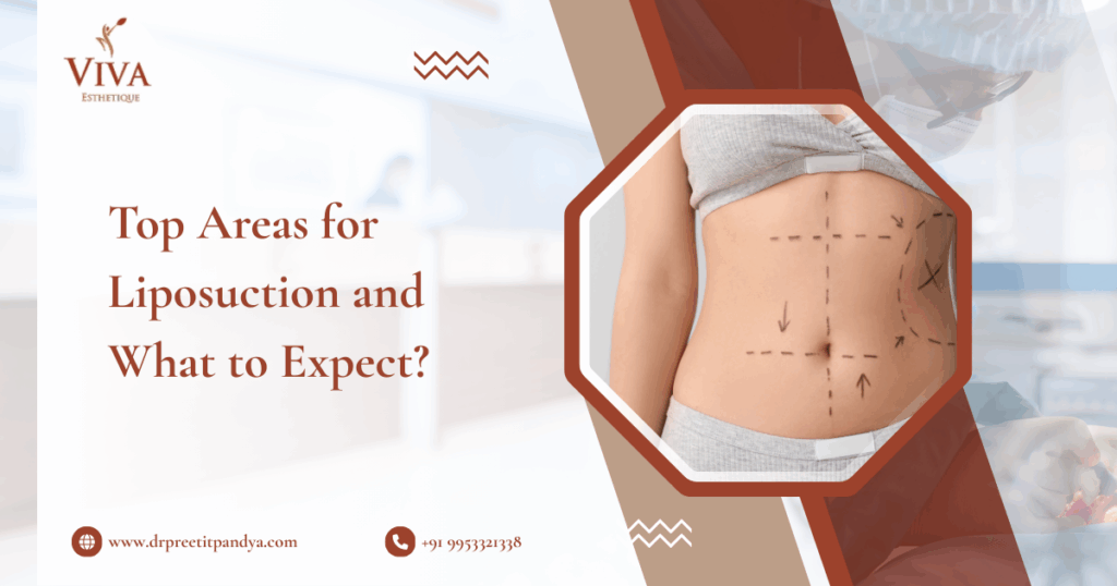 Top Areas for Liposuction and What to Expect- Dr. Preeti Pandya
