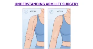 Understanding Arm Lift Surgery